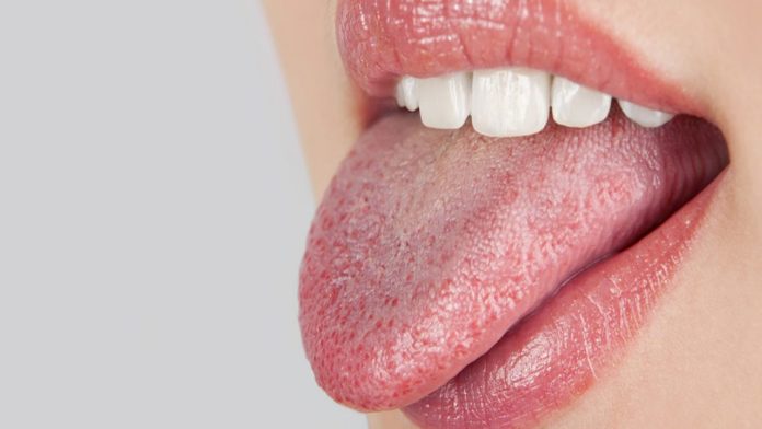 sindrome della bocca urente