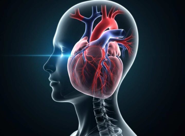 Ictus e infarto, fattore